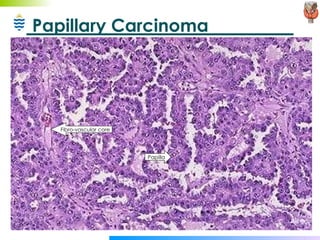 Papillary Carcinoma Papilla Fibro-vascular core 