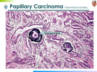 Papillary Carcinoma  Psammoma bodies. Psammoma Body 