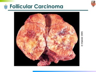 Follicular Carcinoma 