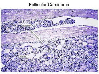 Follicular Carcinoma BV invasion Capsule invasion Follicles 