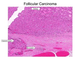 Follicular Carcinoma BV invasion Capsule invasion Follicles 