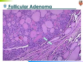 Follicular Adenoma 