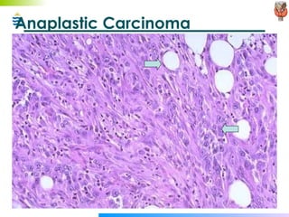 Anaplastic Carcinoma 