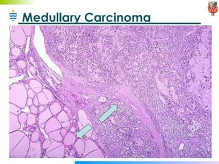Medullary Carcinoma 