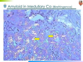 Amyloid in Medullary Ca  (Birefringence) 