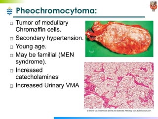 Pheochromocytoma: Tumor of medullary Chromaffin cells. Secondary hypertension. Young age. May be familial (MEN syndrome). Increased catecholamines Increased Urinary VMA  