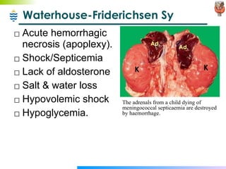 Waterhouse-Friderichsen Sy Acute hemorrhagic necrosis (apoplexy). Shock/Septicemia Lack of aldosterone Salt & water loss Hypovolemic shock Hypoglycemia. The adrenals from a child dying of meningococcal septicaemia are destroyed by haemorrhage. K K Ad. Ad. 