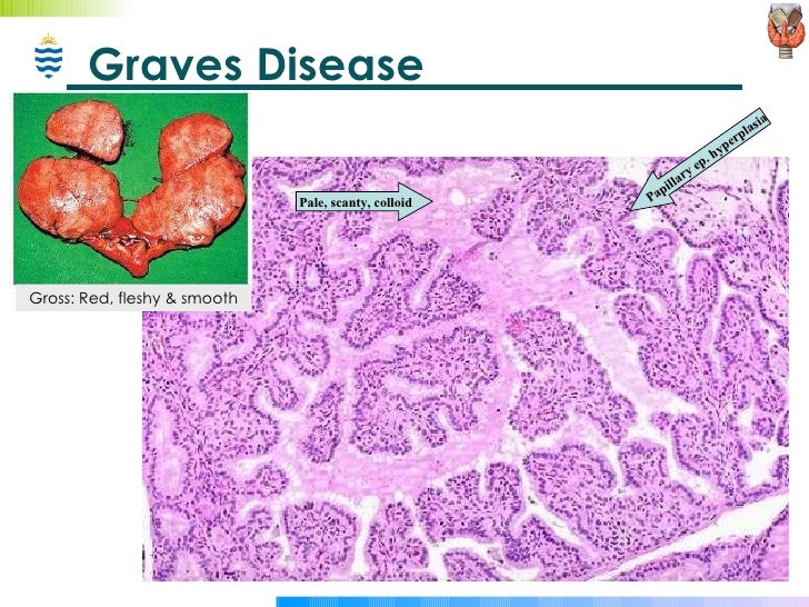 Image Result For Graves Disease Image Result For Graves Disease