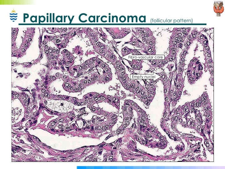 Thyroid Cancer Treatment PDQHealth Professional