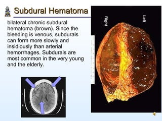 Subdural Hematoma <ul><li>bilateral chronic subdural hematoma (brown). Since the bleeding is venous, subdurals can form mo...