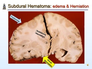 Subdural Hematoma:  edema & Herniation Flattening Subfalcine Herniation Uncal Herniation 