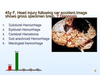 45y F, Head injury following car accident.Image shows gross specimen brain.  ? Diagnosis <ul><li>Subdural Hemorrhage </li>...