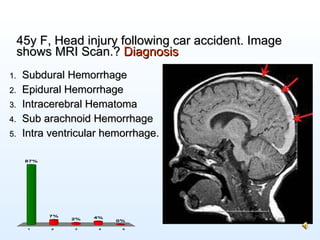 45y F, Head injury following car accident. Image shows MRI Scan.?  Diagnosis <ul><li>Subdural Hemorrhage </li></ul><ul><li...