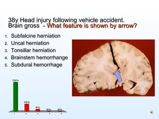 38y Head injury following vehicle accident. Brain gross   -  What feature is shown by arrow? <ul><li>Subfalcine herniation...