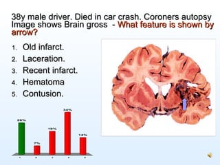 38y male driver. Died in car crash. Coroners autopsy Image shows Brain gross  -   What feature is shown by arrow? <ul><li>...