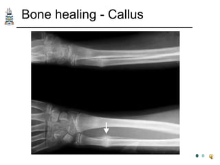 Bone Callouses Pathology of Trauma | PPT