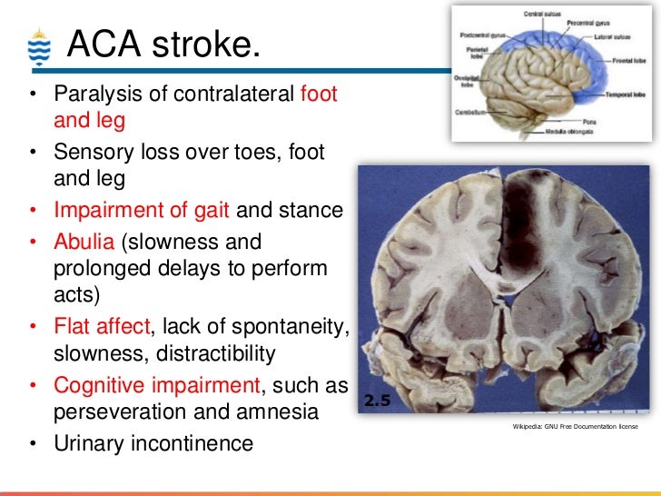 presentation of aca stroke