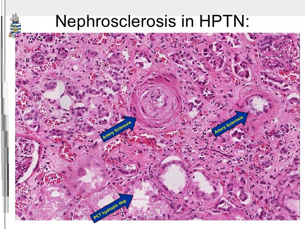Артериолосклеротический нефросклероз рисунок