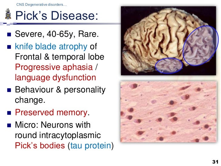 Pathology of CNS Degenerations Lecture