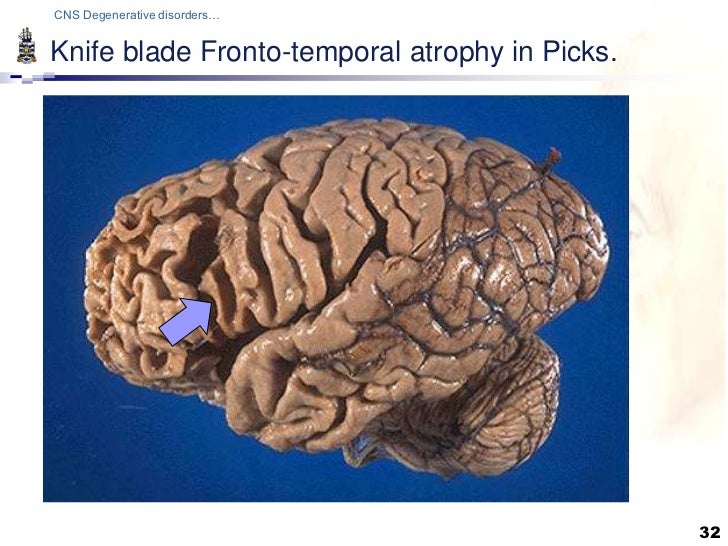 Pathology of CNS Degenerations Lecture