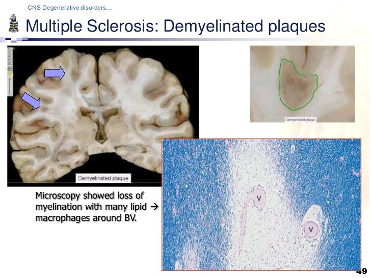 Pathology of CNS Degenerations Lecture