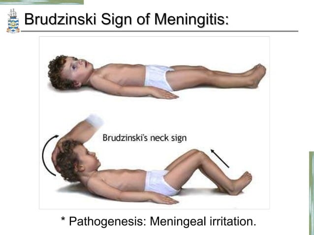 Pathology of Meningitis CNS infections