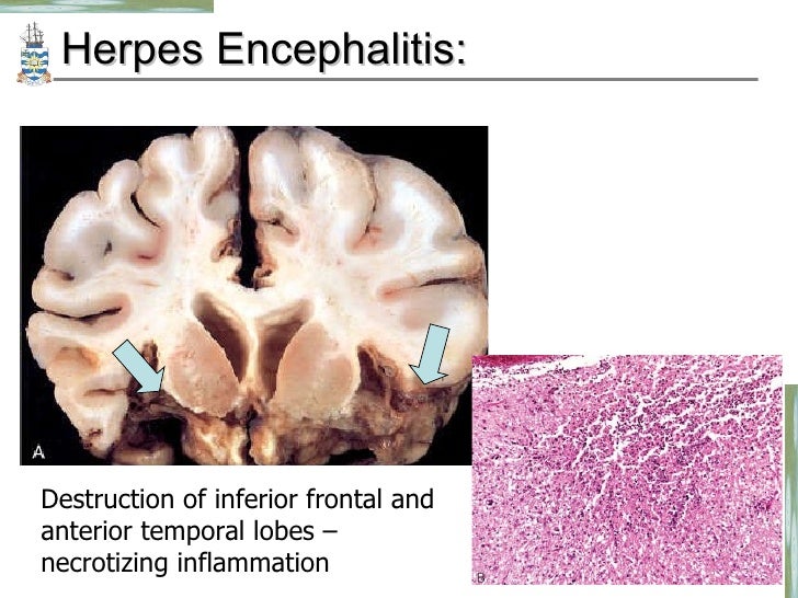 Pathology Of Meningitis Cns Infections