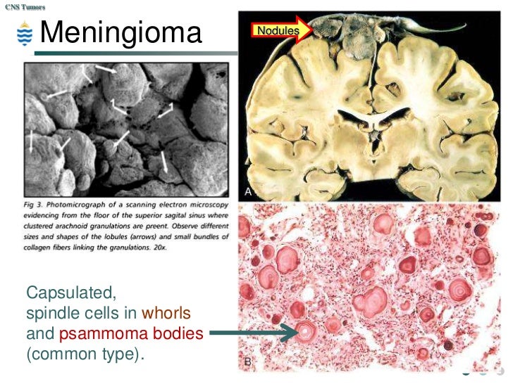 Pathology of CNS Tumours Lecture