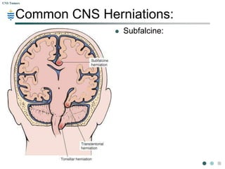 Pathology of CNS Tumors | PPTX