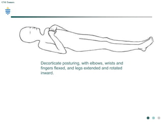 Arm Posturing Inward Pathology of CNS Tumors | PPTX