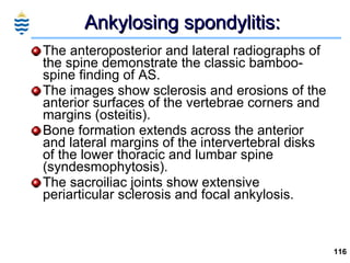 Ankylosing spondylitis: <ul><li>The anteroposterior and lateral radiographs of the spine demonstrate the classic bamboo-sp...