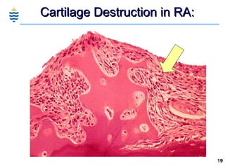 Cartilage Destruction in RA: 