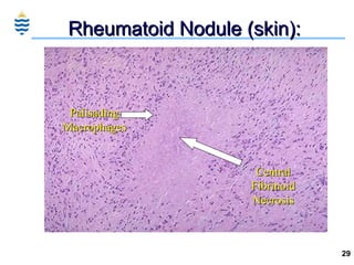 Rheumatoid Nodule (skin): Palisading Macrophages Central Fibrinoid Necrosis 