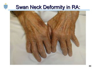 Swan Neck Deformity in RA: 