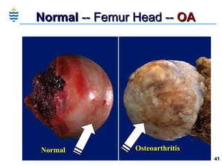 Normal  -- Femur Head --  OA Normal Osteoarthritis 