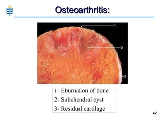 Osteoarthritis: 1- Eburnation of bone 2- Subchondral cyst 3- Residual cartilage 