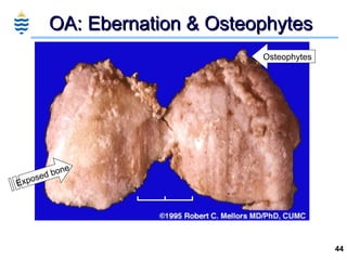 OA: Ebernation & Osteophytes Exposed bone Osteophytes 