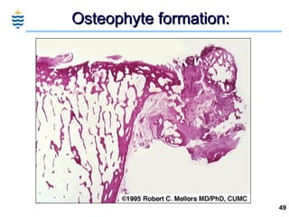 Osteophyte formation: 