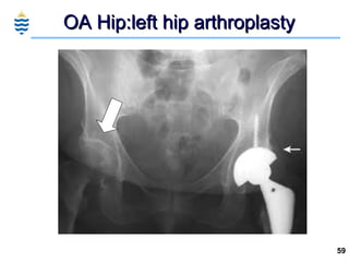 OA Hip:left hip arthroplasty  