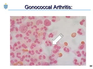 Gonococcal Arthritis: 
