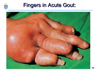 Fingers in Acute Gout: 