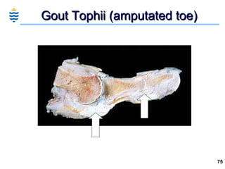 Gout Tophii (amputated toe) 