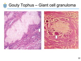 Gouty Tophus – Giant cell granuloma 