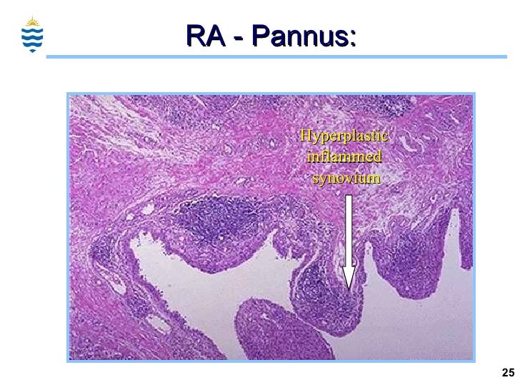 Pathology of Arthritis