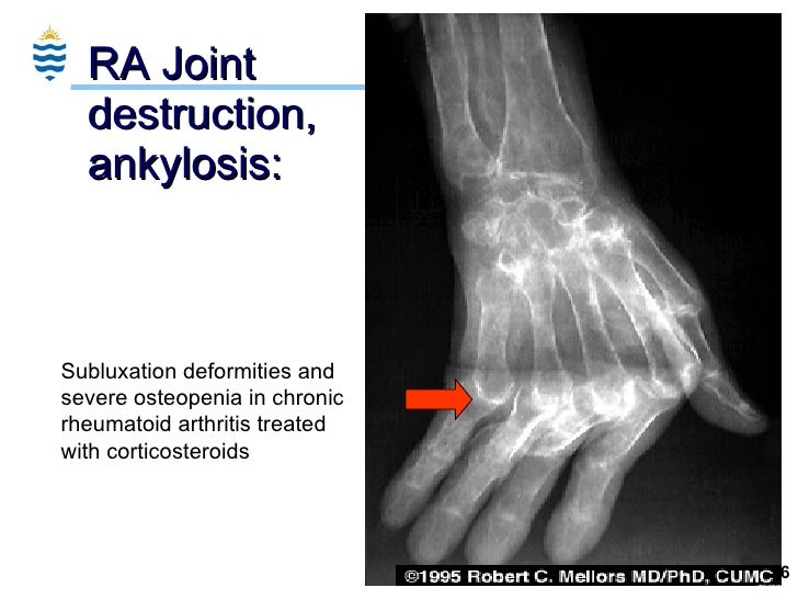Pathology of Arthritis