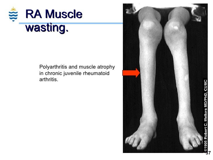 Pathology of Arthritis