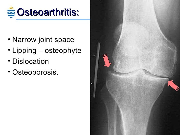 Pathology of Arthritis