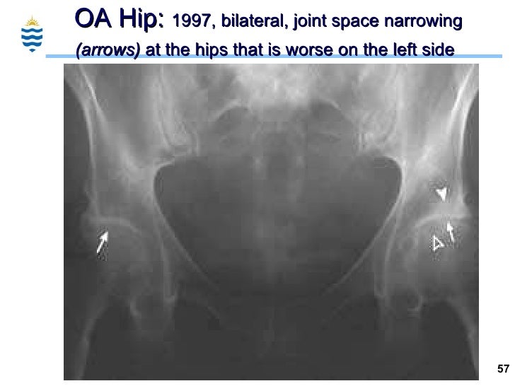 Pathology of Arthritis