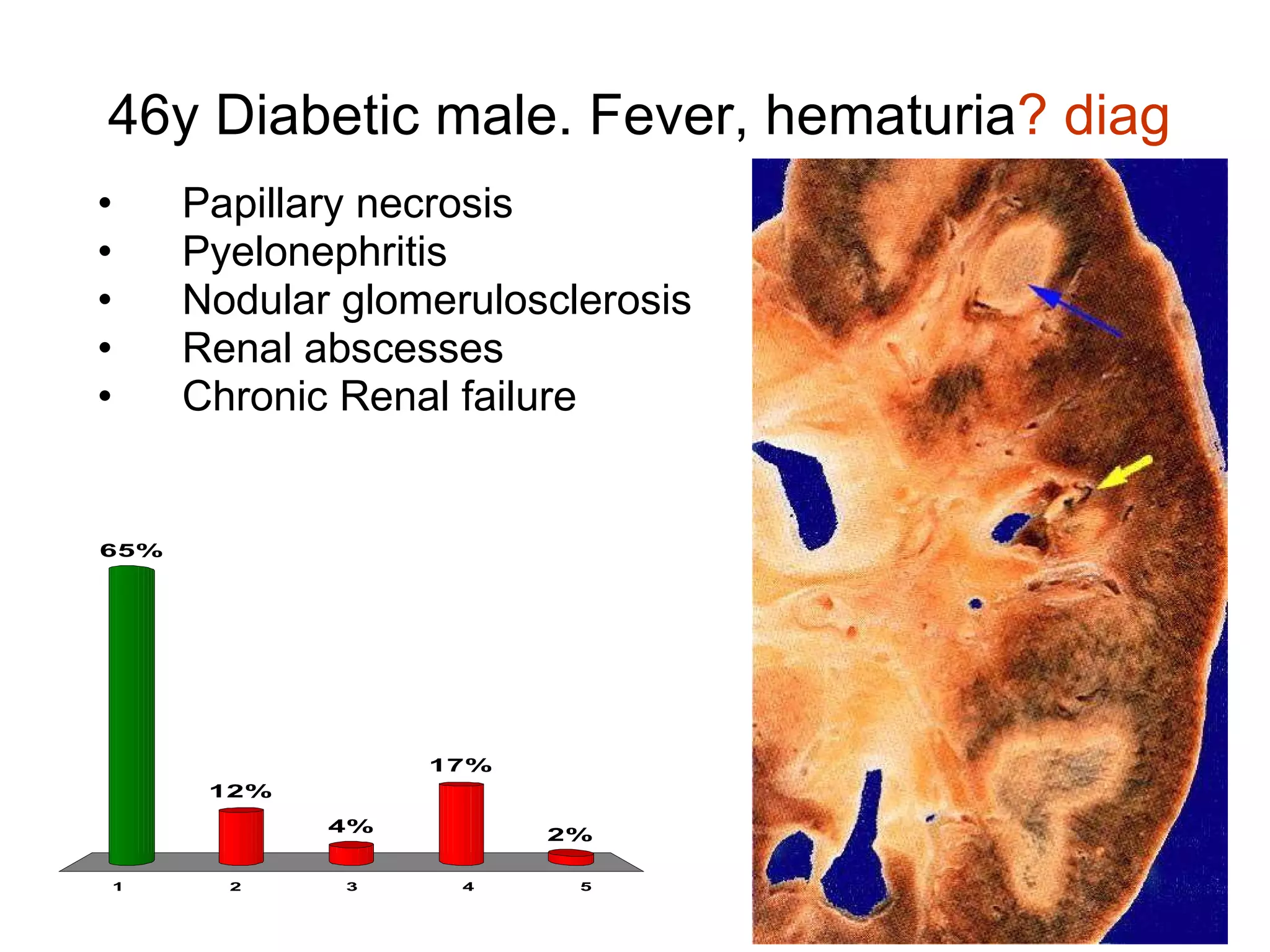 46y Diabetic male. Fever, hematuria ? diag Papillary necrosis Pyelonephritis Nodular glomerulosclerosis Renal abscesses Chronic Renal failure 