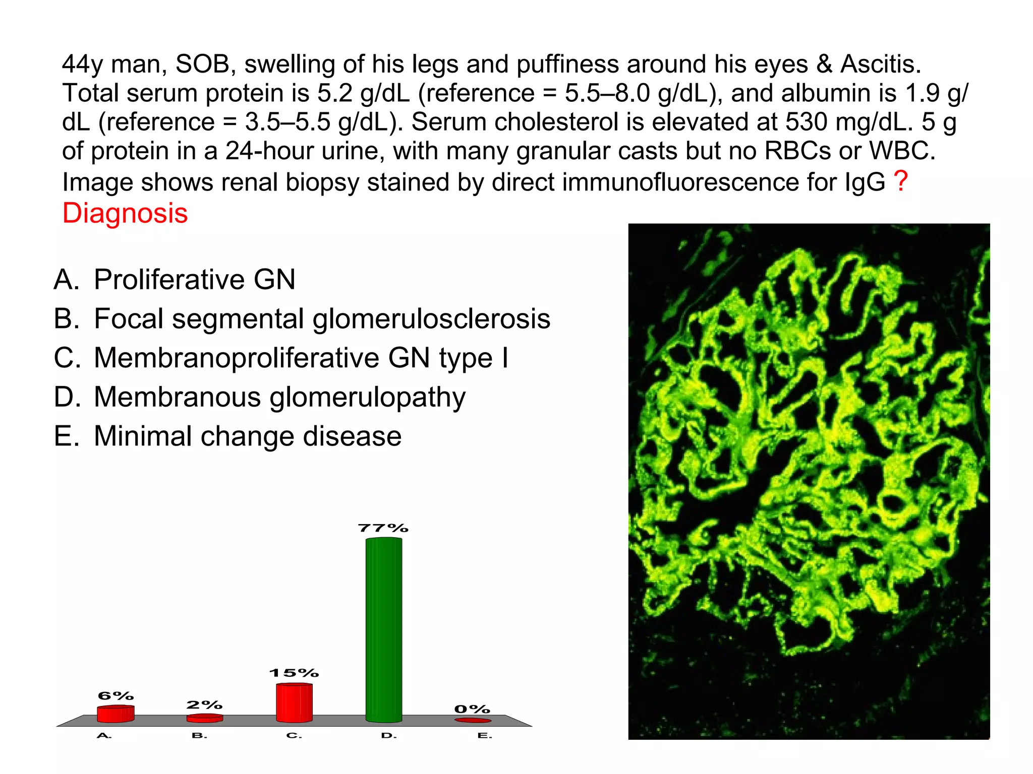 44y man, SOB, swelling of his legs and puffiness around his eyes & Ascitis. Total serum protein is 5.2 g/dL (reference = 5.5–8.0 g/dL), and albumin is 1.9 g/dL (reference = 3.5–5.5 g/dL). Serum cholesterol is elevated at 530 mg/dL. 5 g of protein in a 24-hour urine, with many granular casts but no RBCs or WBC. Image shows renal biopsy stained by direct immunofluorescence for IgG  ? Diagnosis Proliferative GN Focal segmental glomerulosclerosis Membranoproliferative GN type I Membranous glomerulopathy Minimal change disease 